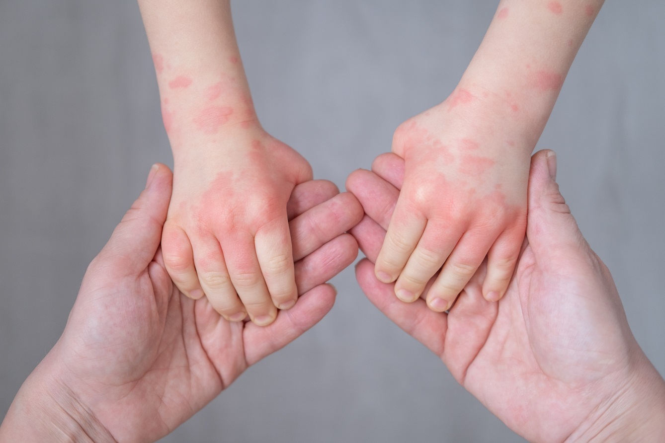 Alergia pokarmowa u dzieci